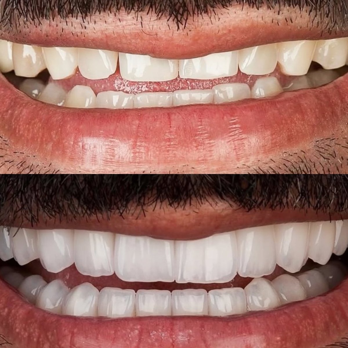 Before and after veneers at Alar Dent - Oral and Dental Health Clinic, smile makeover result