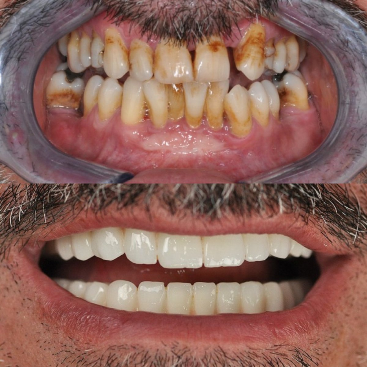 Résultat avant/après implants All-on-6 à Dera Dental Clinic, sourire restauré