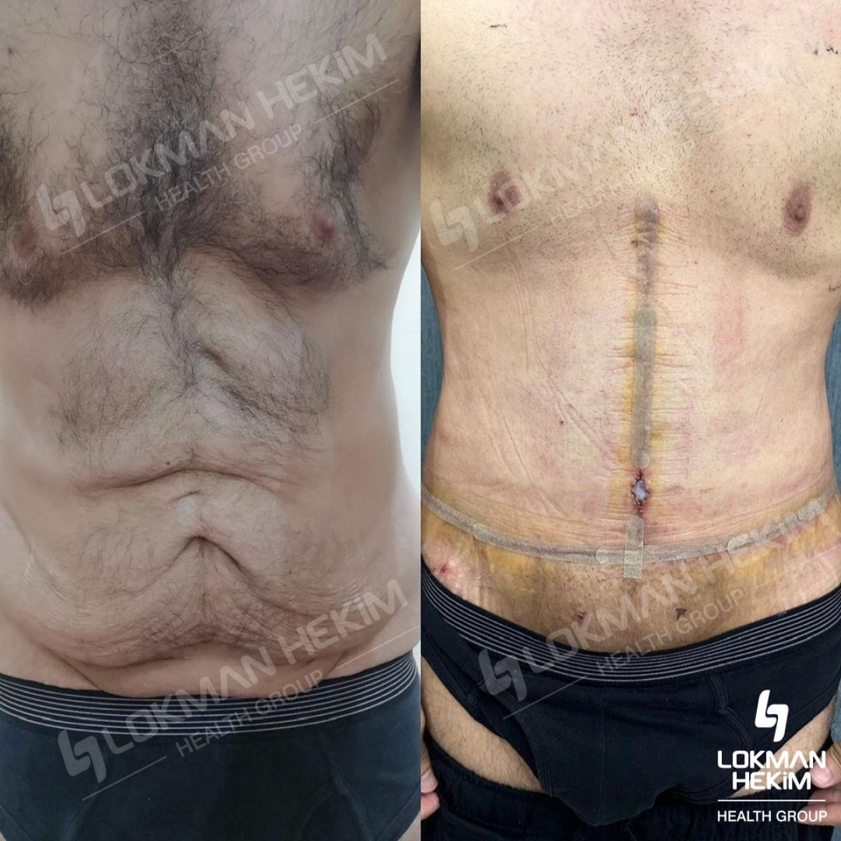 Before and after abdominal etching results at Lokman Hekim Istanbul Hospital, six pack abs