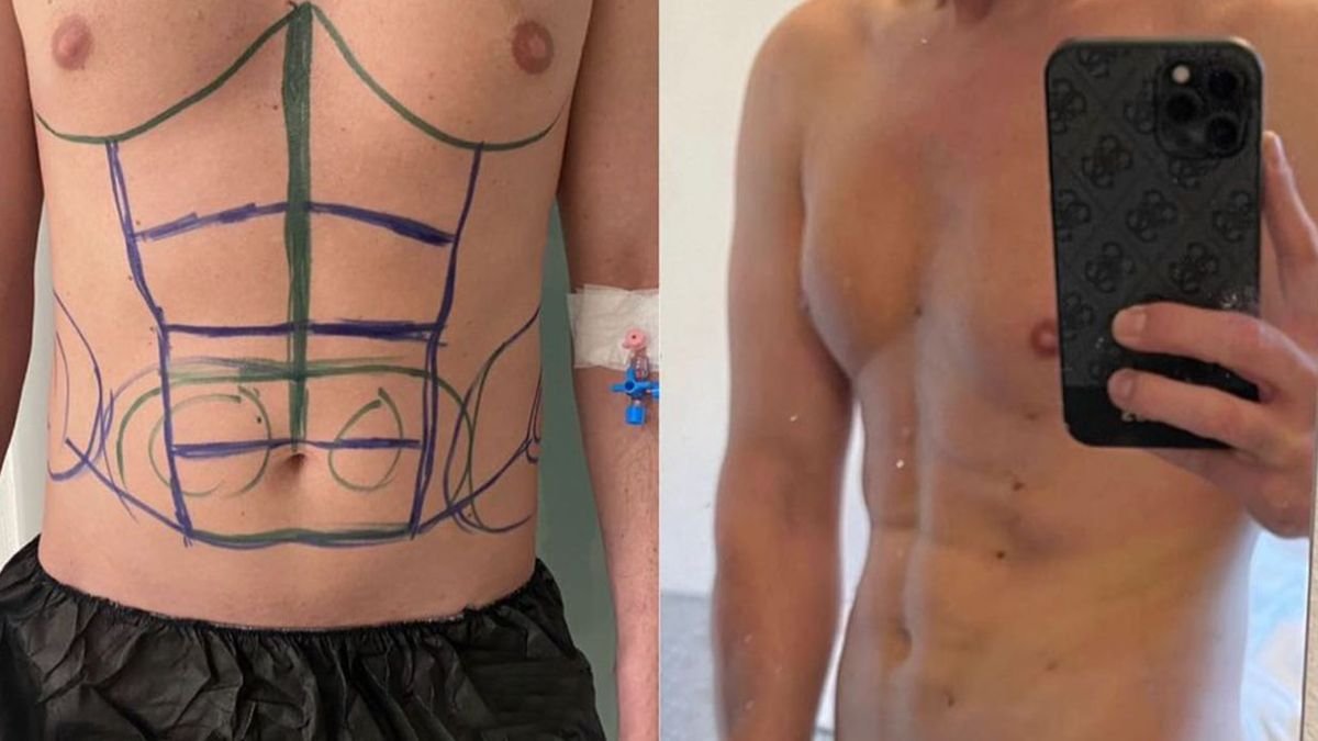 Before and after abdominal etching results at Lokman Hekim Istanbul Hospital, six pack abs