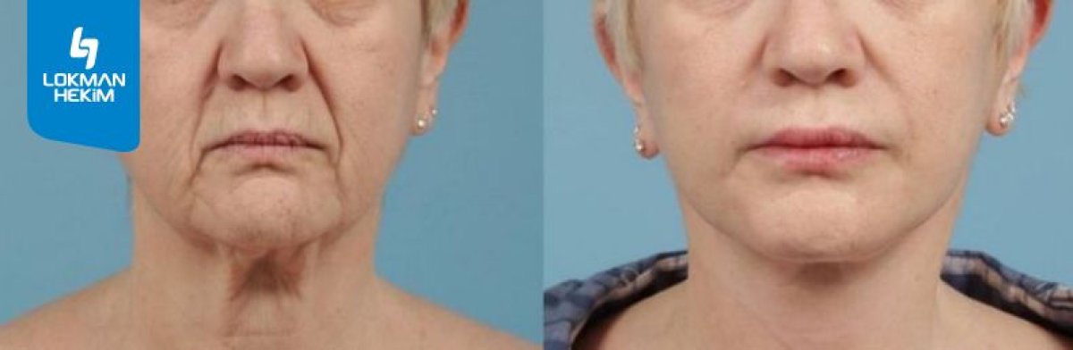Результаты до и после deep plane SMAS-лифтинга в Lokman Hekim Istanbul Hospital, омоложение лица