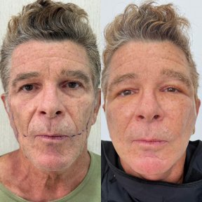 Premium Facelift All Included - photo 5