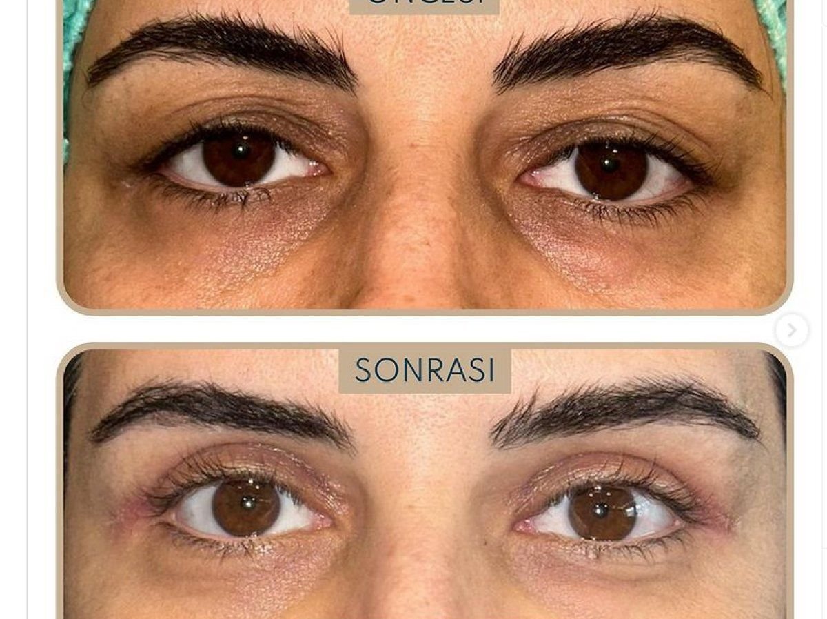 Blepharoplasty before and after results at Dunyagoz Eye Hospital Istanbul Etiler, eyelid correction