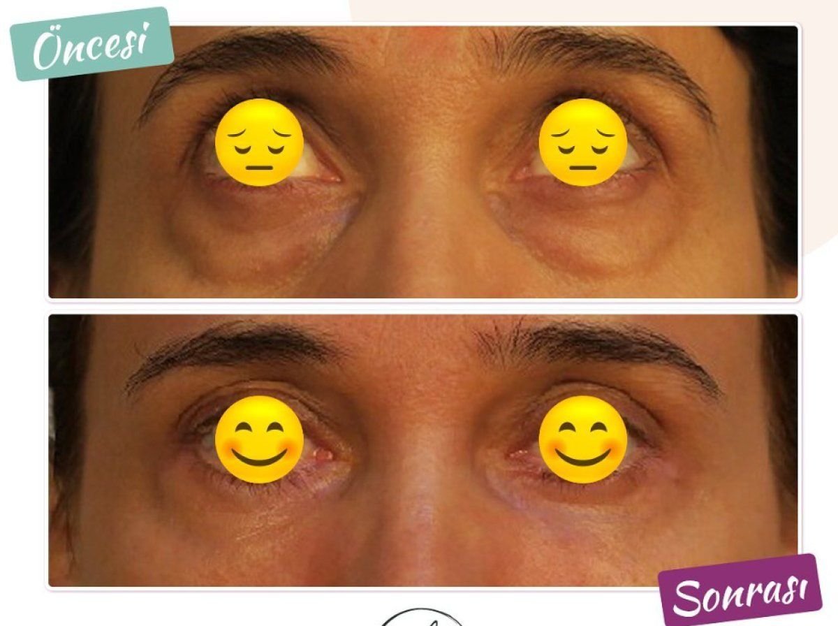 Blepharoplasty before and after results at Dunyagoz Eye Hospital Istanbul Etiler, eyelid correction