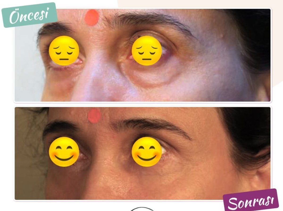 Blepharoplasty before and after results at Dunyagoz Eye Hospital Istanbul Etiler, eyelid correction