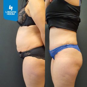 Premium Tummy tuck All Included - photo 4