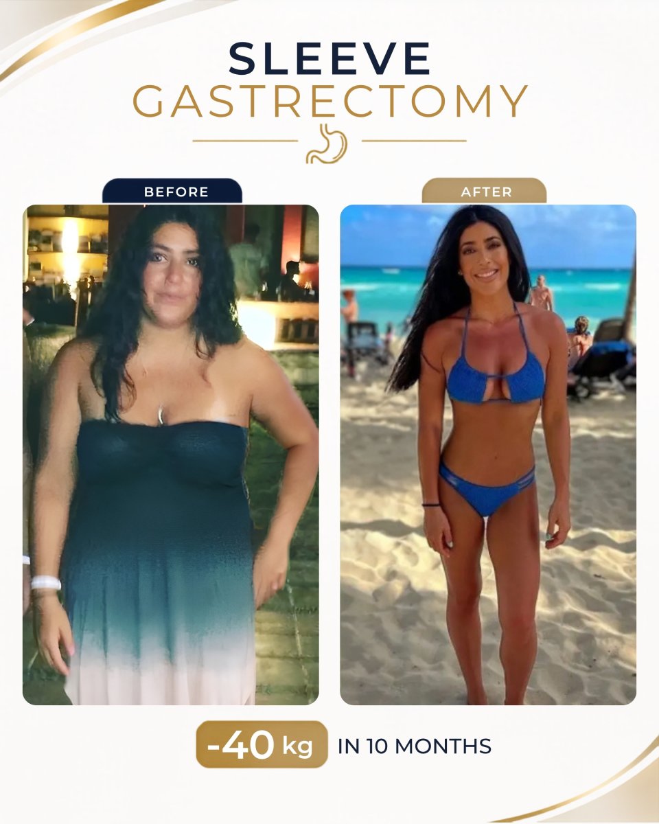 Before and after gastric sleeve surgery at Estexper Clinic – 40 kg weight loss result in 10 months