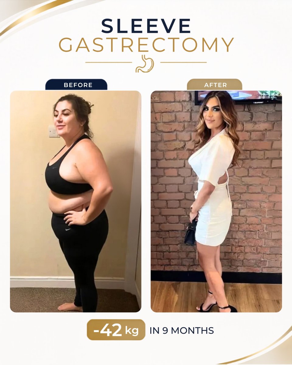 Before and after gastric sleeve surgery at Estexper Clinic – 42 kg weight loss in 9 months