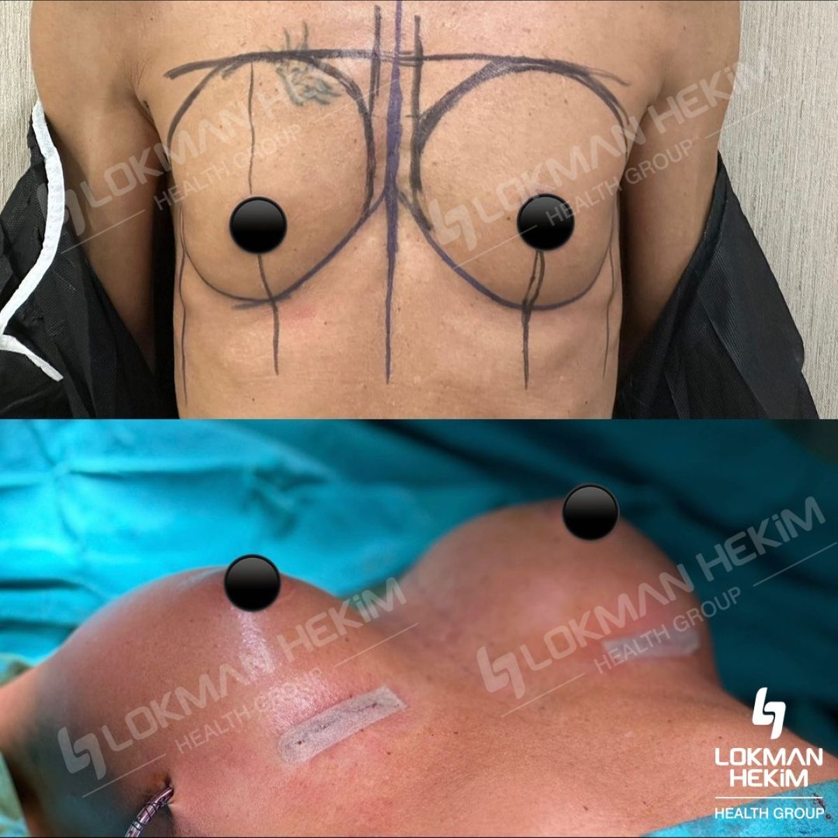 Before and after breast augmentation with silicone implants at Lokman Hekim Istanbul Hospital