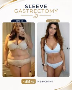 Standard Gastric sleeve surgery (Sleeve gastrectomy) All Included - photo 4