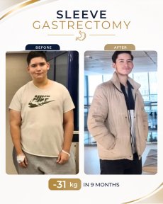 Standard Gastric sleeve surgery (Sleeve gastrectomy) All Included - photo 6