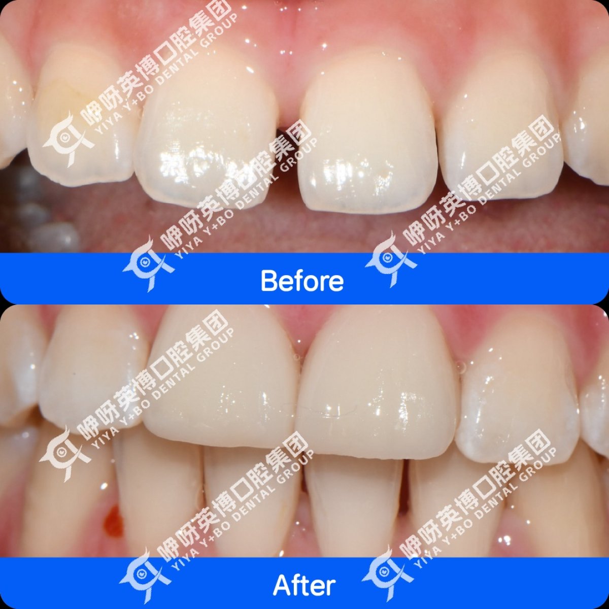 Before and after veneers result at Shanghai Y+bo Dental Clinic, improved smile aesthetics