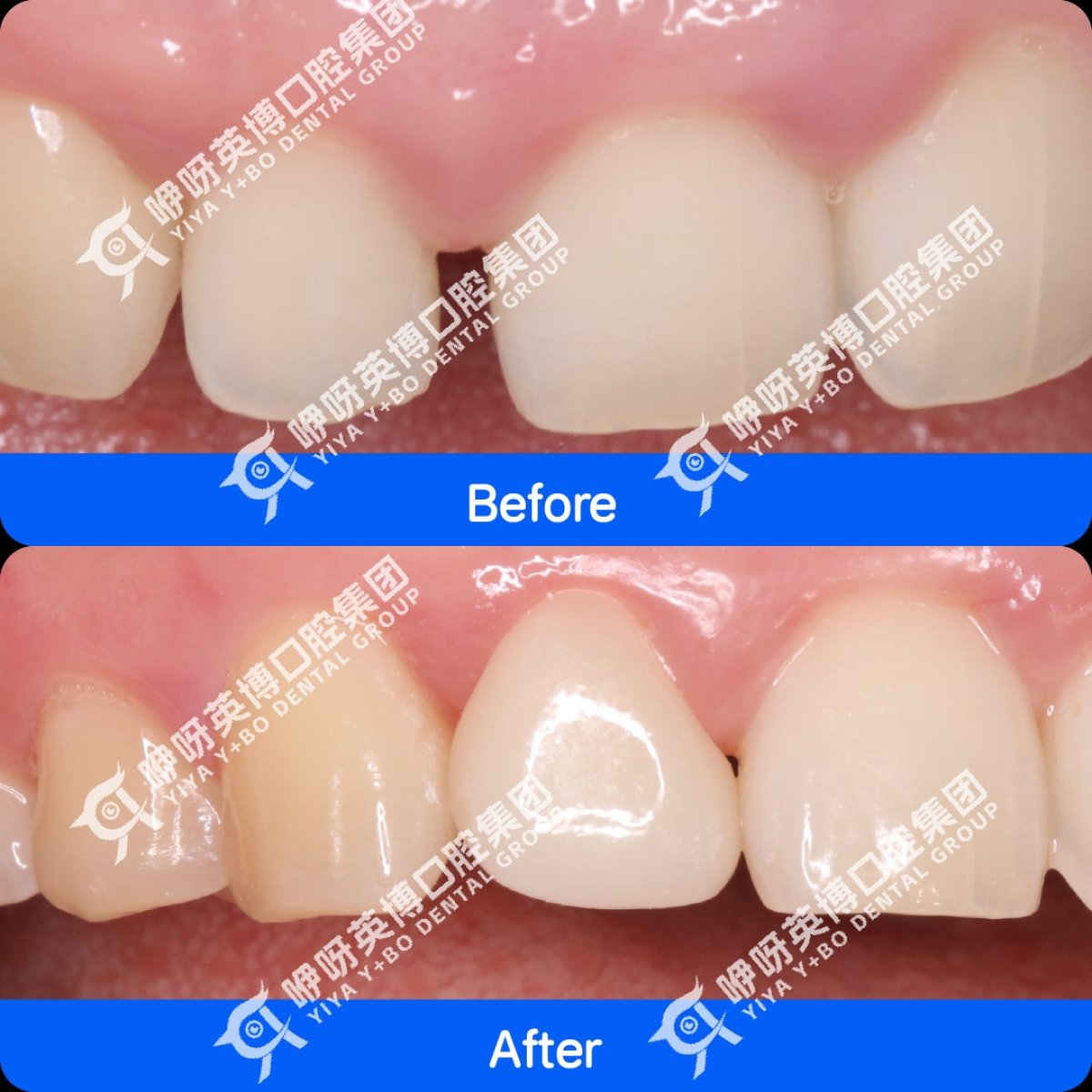 Before and after dental veneers result at Shanghai Y+bo Dental Clinic, improved front teeth