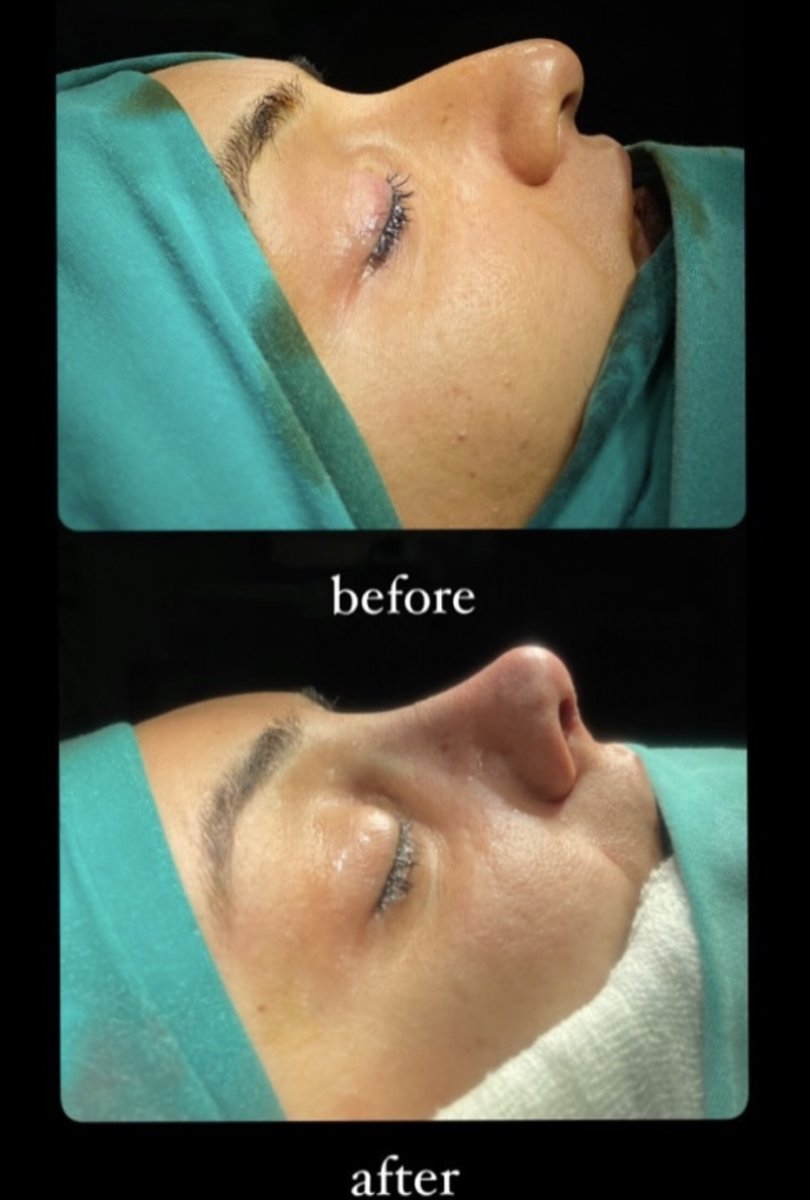 Resultados de rinoplastia antes y después en Büyük Anadolu Hospitals, forma de nariz mejorada