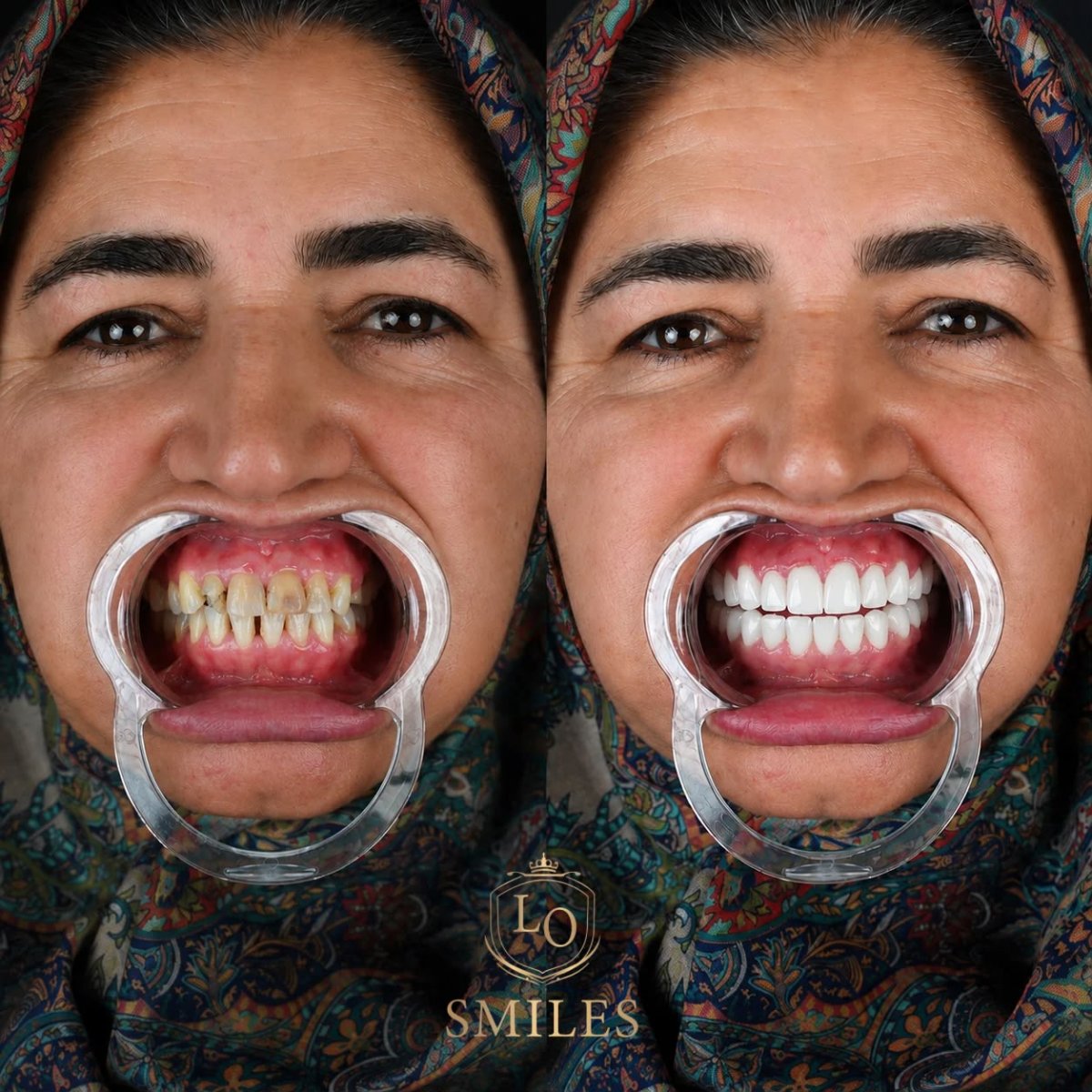 До и после установки виниров в клинике LO Smiles – результат преображения улыбки