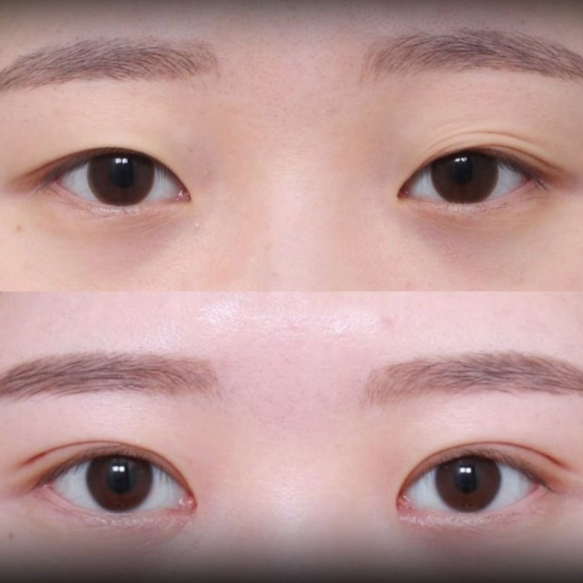 Before and after blepharoplasty results at VG Plastic Surgery, eyelid correction improvement