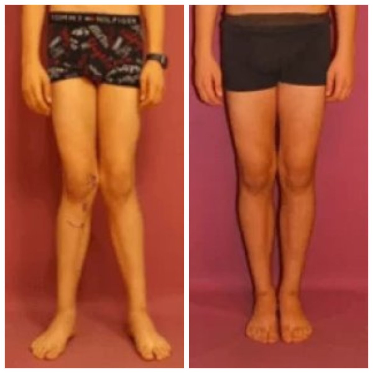 Resultados antes y después de cirugía de deformidad en valgo en Ortopediatri, piernas alineadas