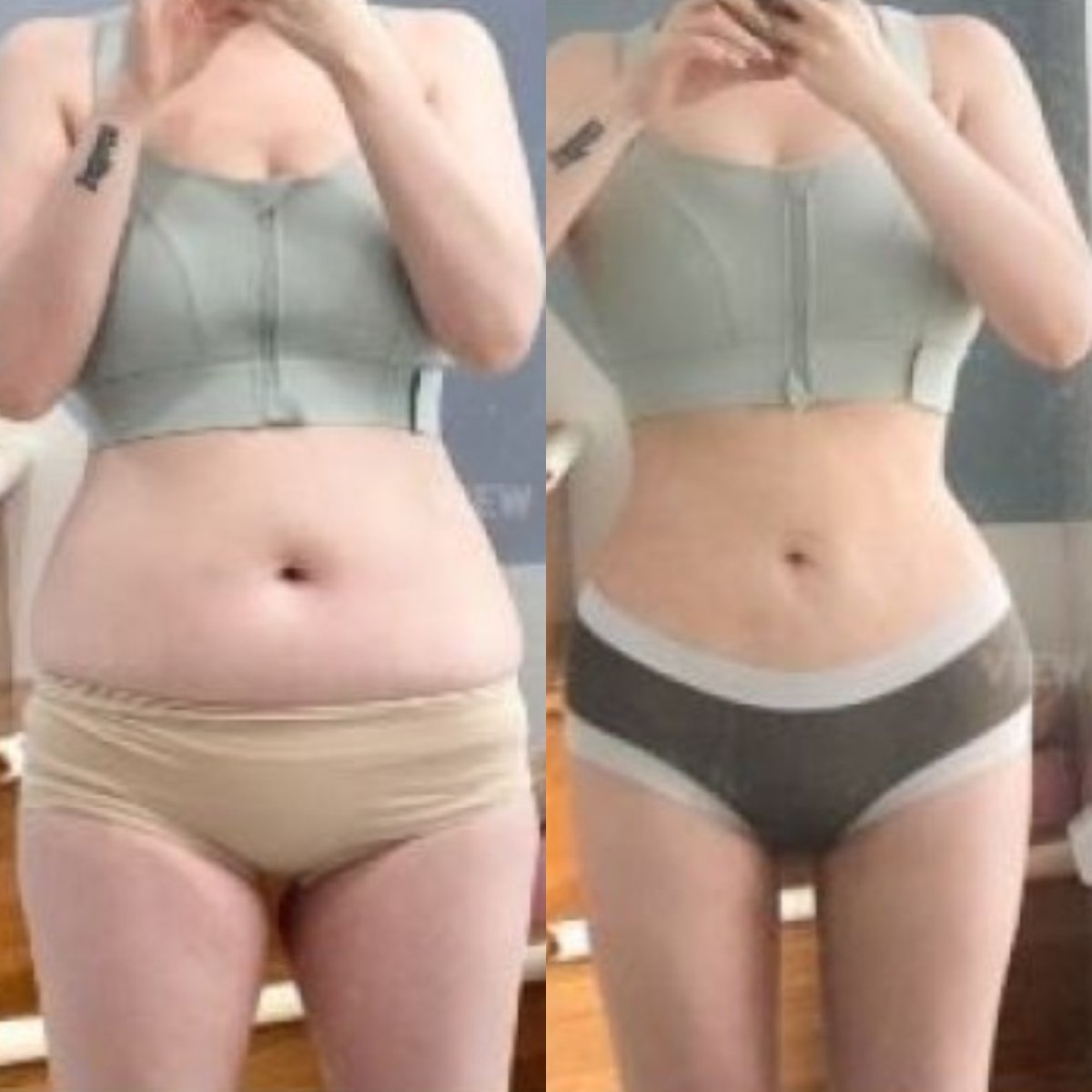 Résultats avant et après liposuccion à View Plastic Surgery Hospital, taille affinée