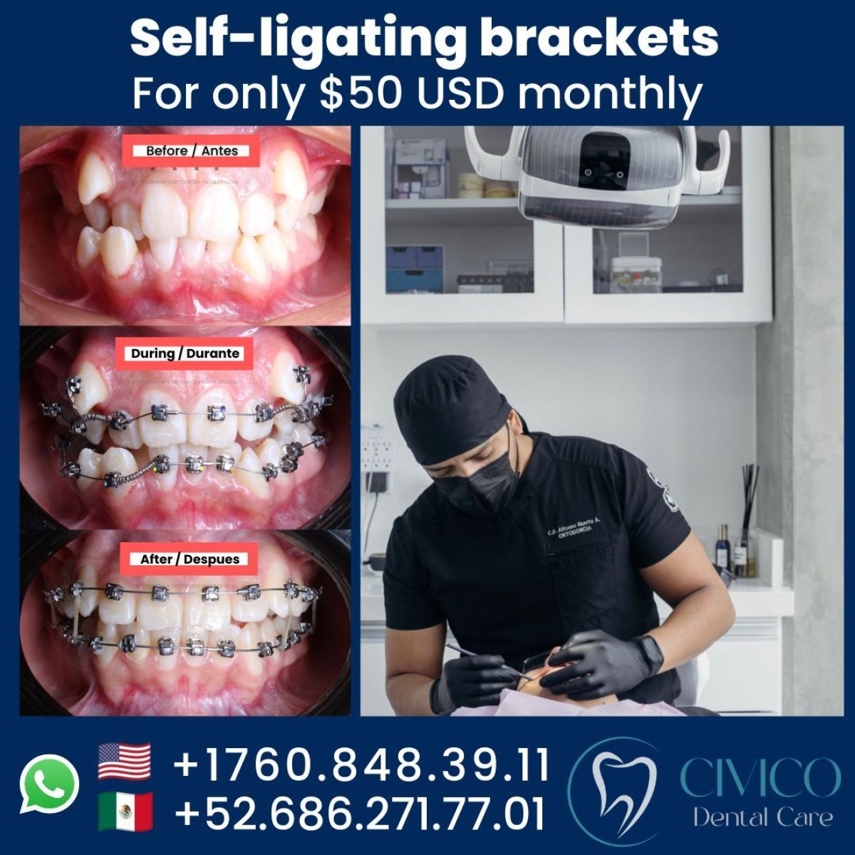 Результаты до и после самолигирующих брекетов в CIVICO DENTAL CARE MEXICALI, выравнивание зубов