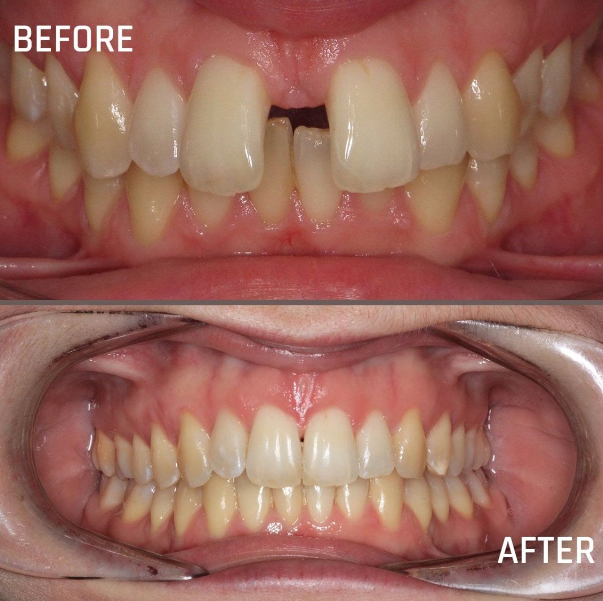 Resultados antes y después de brackets en CIVICO DENTAL CARE MEXICALI, alineación dental