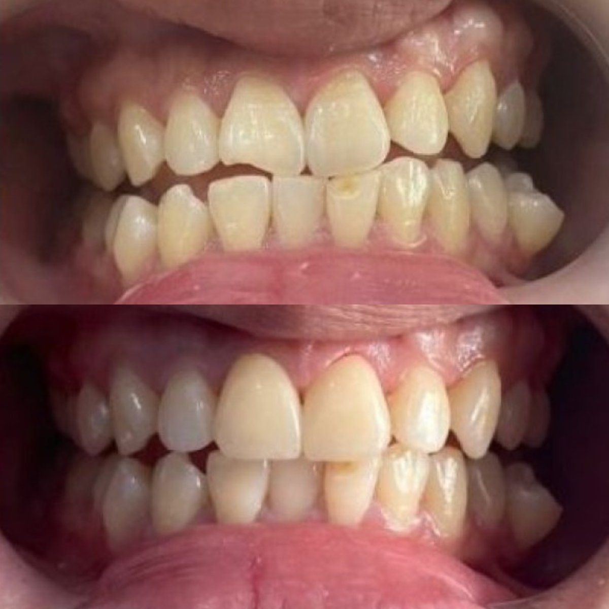 نتائج قبل وبعد قشور البورسلين في عيادة Dr. Smile Dental Clinic، تحسين جمالية الابتسامة