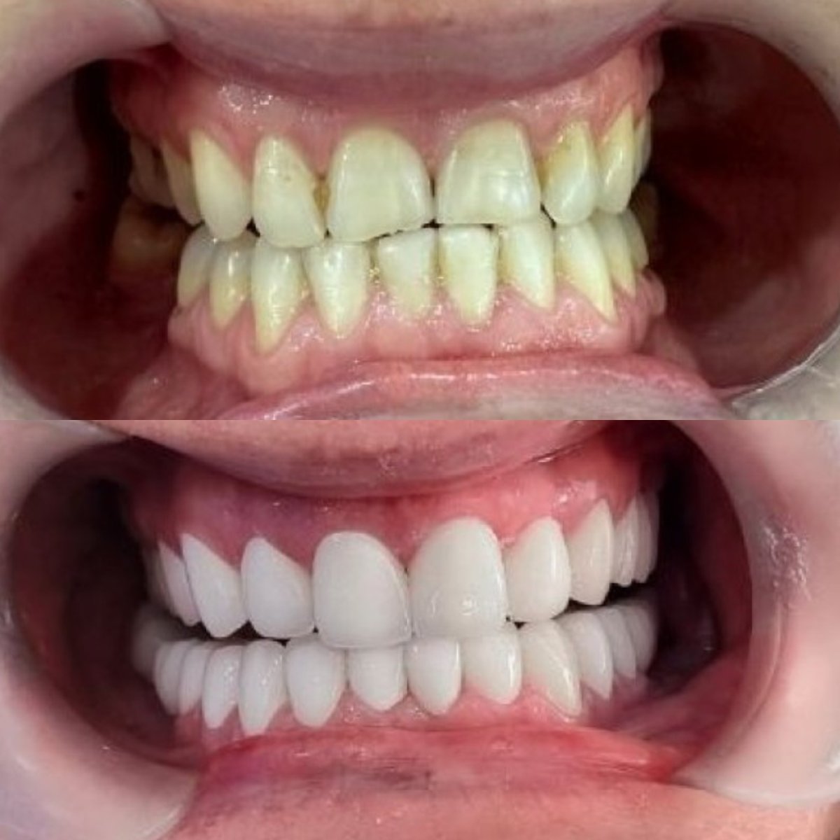 До и после установки виниров в Dr. Smile Dental Clinic, преображение улыбки с естественным результатом