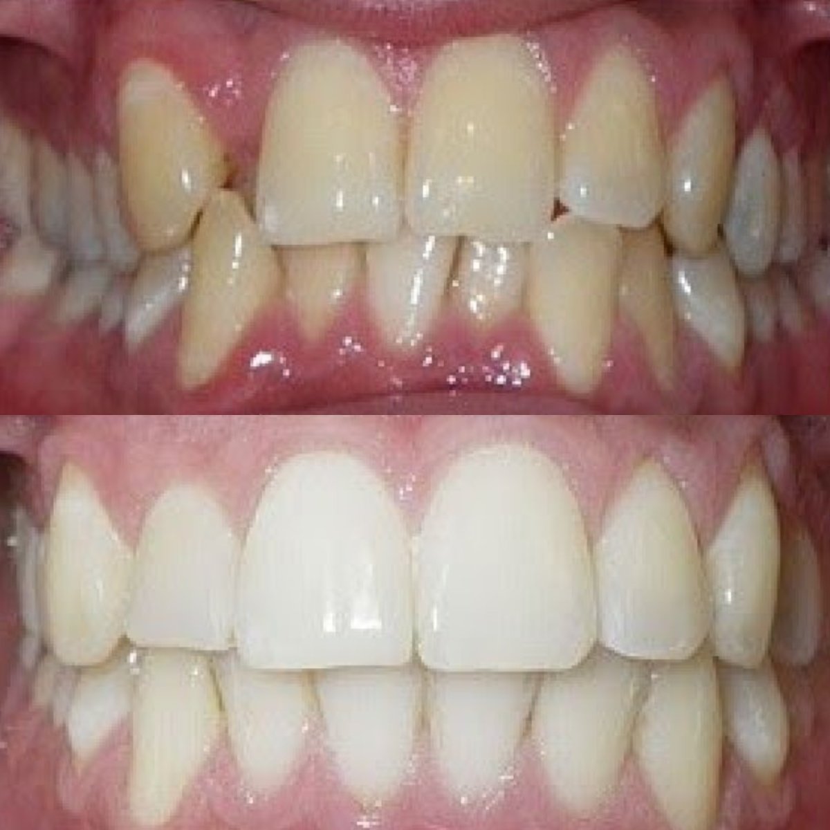 До та після встановлення вінірів у Dr. Smile Dental Clinic – рівні та білі зуби
