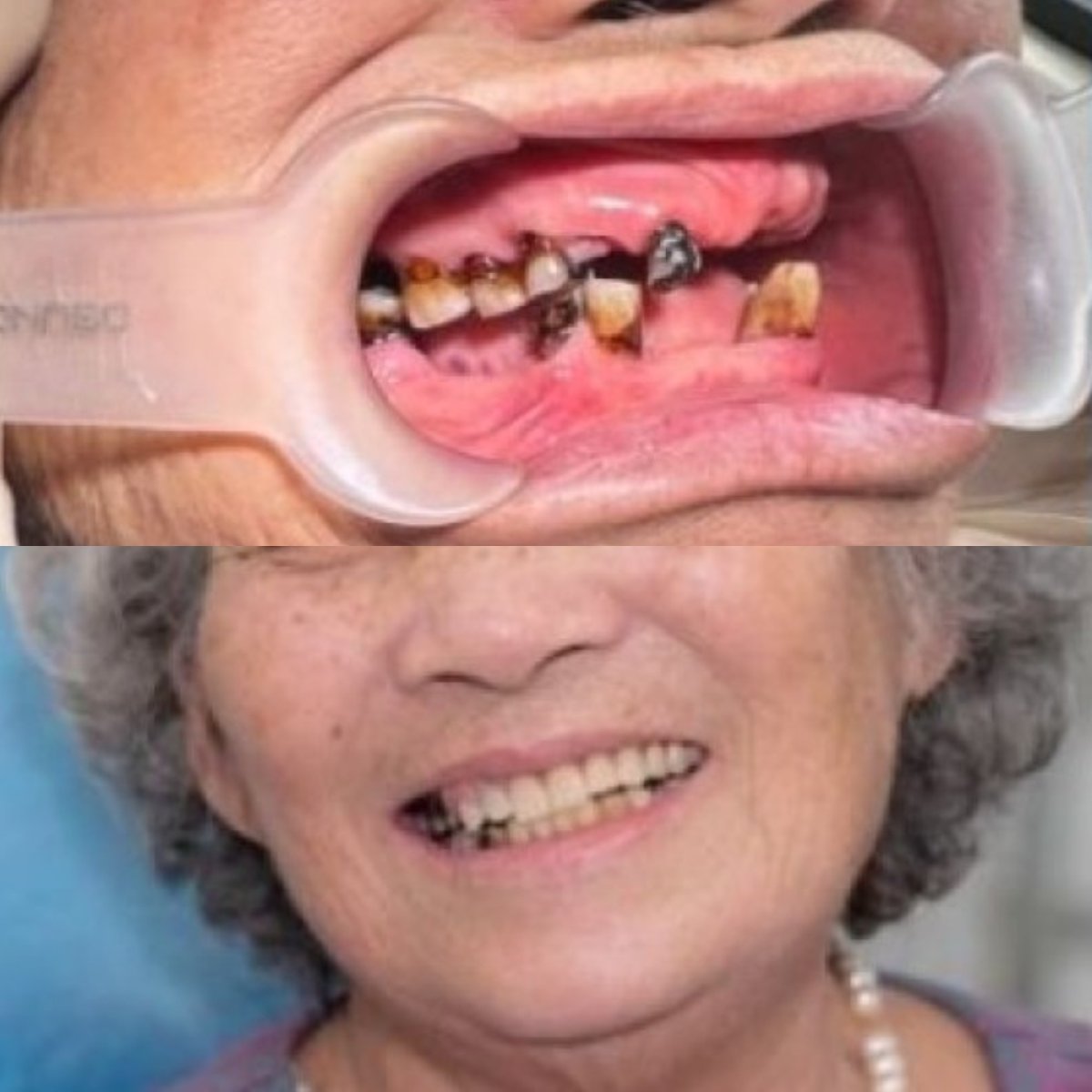 Efekty przed i po protezie zębowej w Dr. Smile Dental Clinic – poprawa uśmiechu