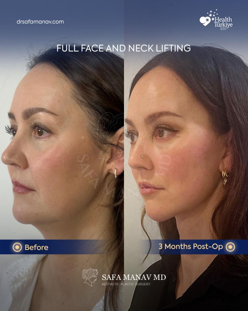 Before and after facelift and neck lift results at Dr. Safa Manav Clinic, 3 months post-op
