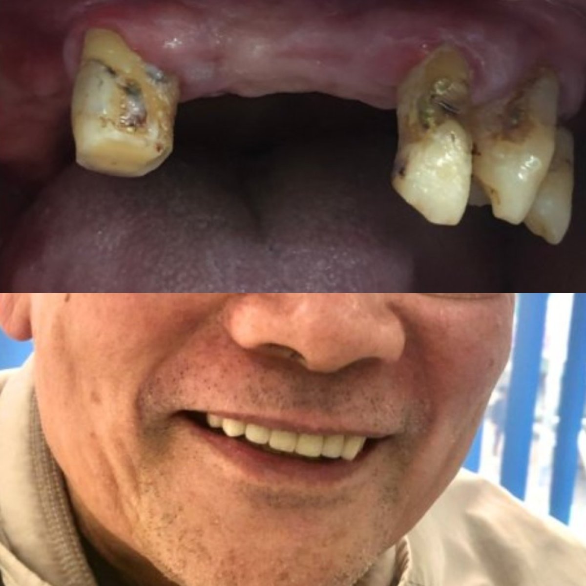 Efekty przed i po protezie zębowej w Dr. Smile Dental Clinic – odnowiony uśmiech