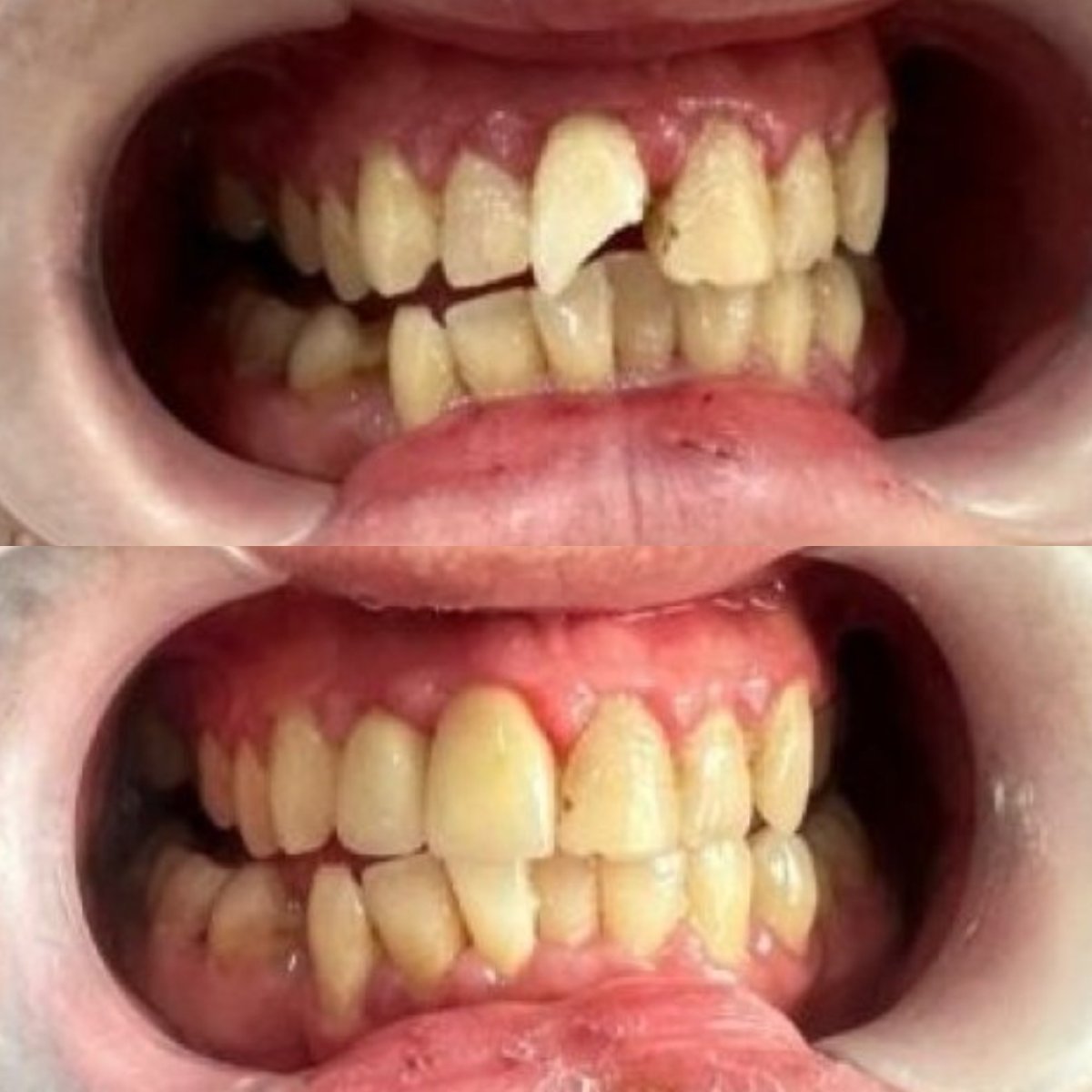 Efekty przed i po odbudowie ukruszonych zębów bondingiem w Dr. Smile Dental Clinic
