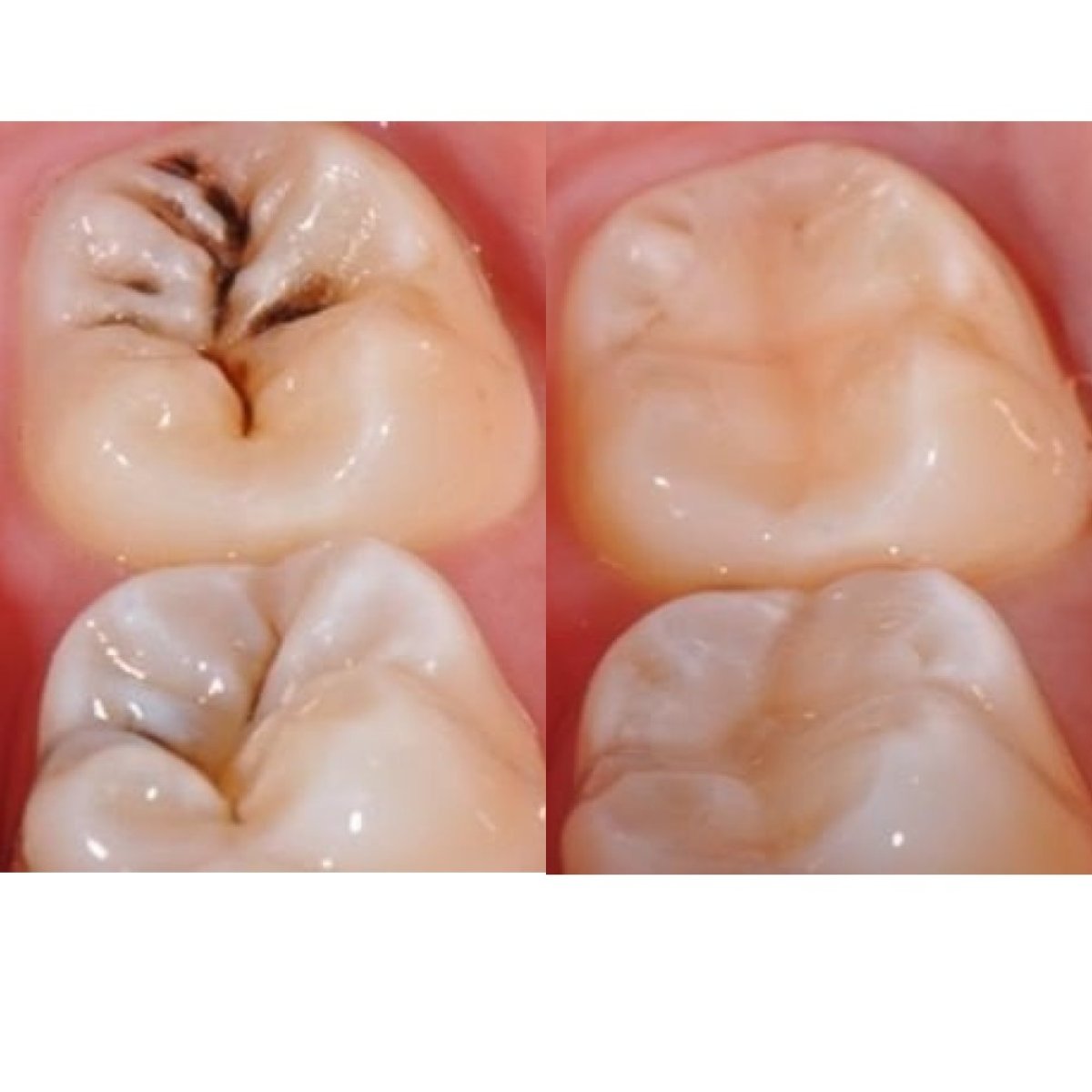 Efekty przed i po wypełnieniu kompozytowym w Dr. Smile Dental Clinic na próchnicę