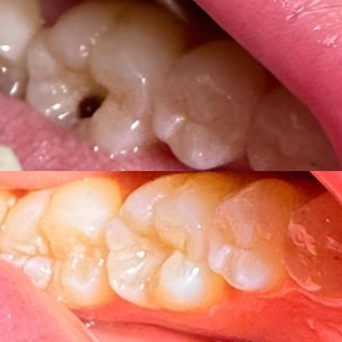 Efekt przed i po wypełnieniu kompozytowym w Dr. Smile Dental Clinic na leczenie próchnicy