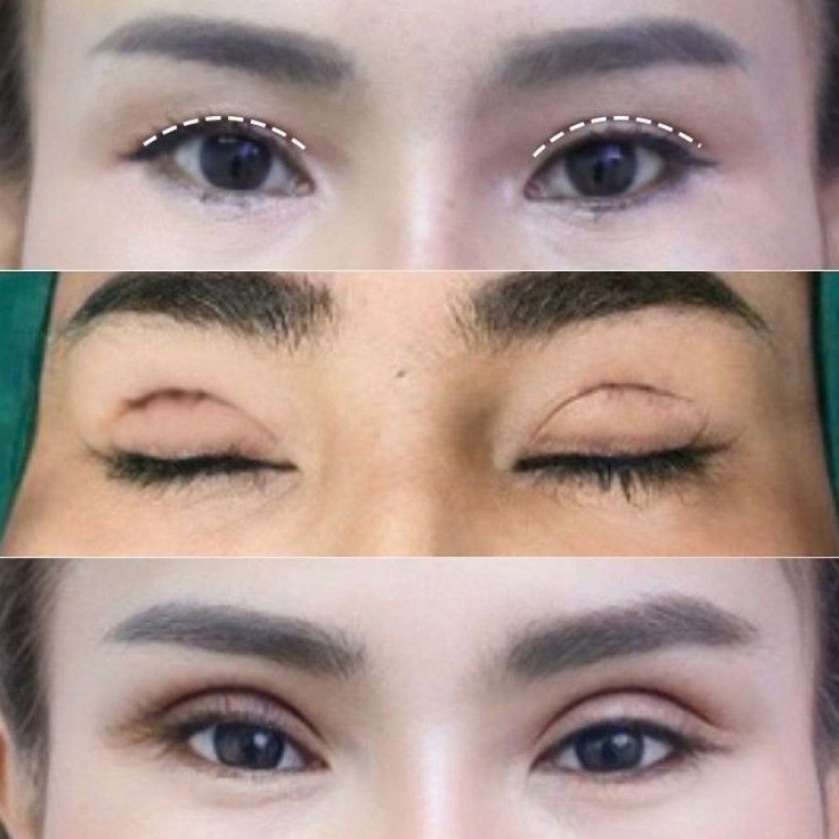 نتائج رأب الجفن قبل وبعد في Asia Cosmetic Hospital، تصحيح الجفون