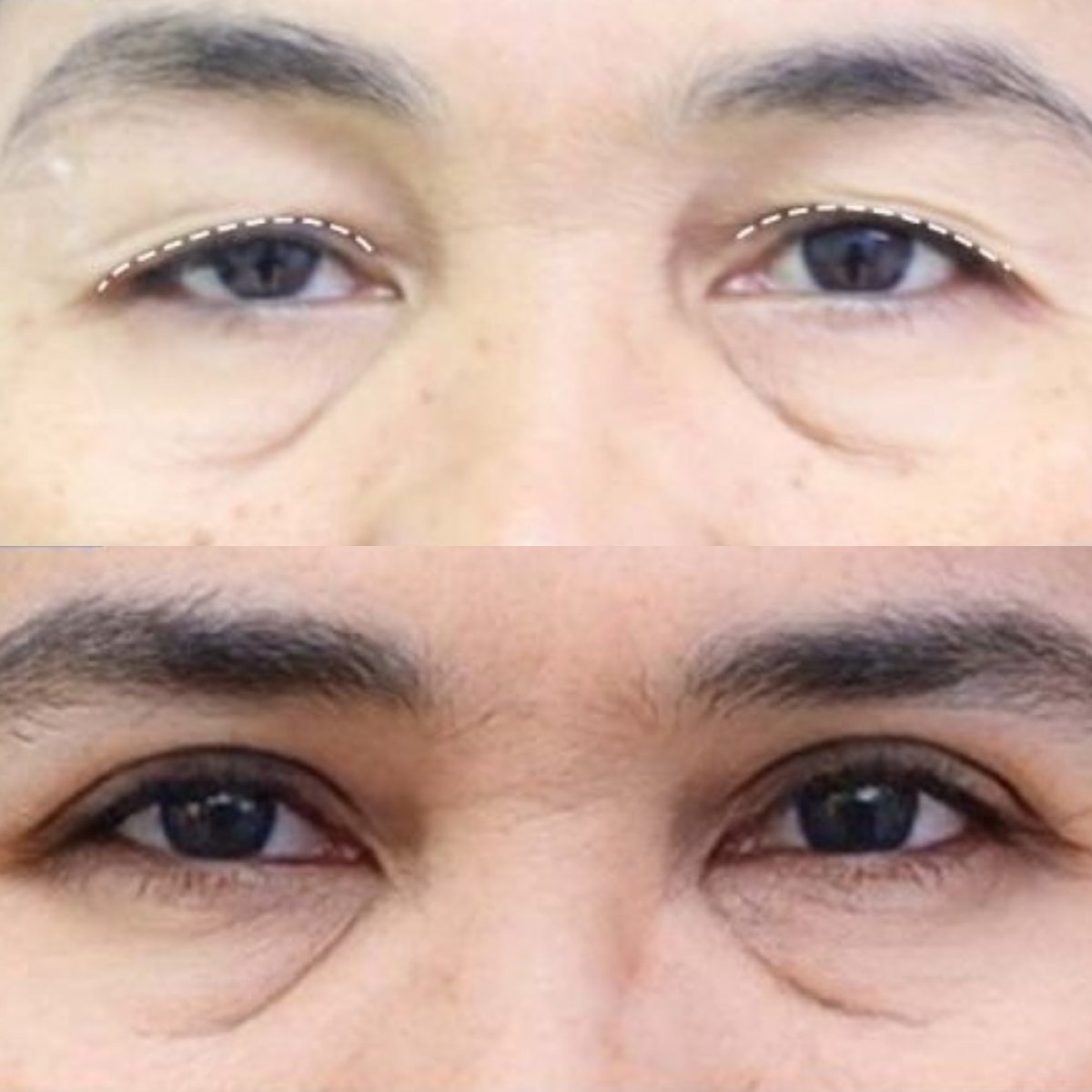 نتائج شد الجفون قبل وبعد في Asia Cosmetic Hospital، تصحيح الجفون