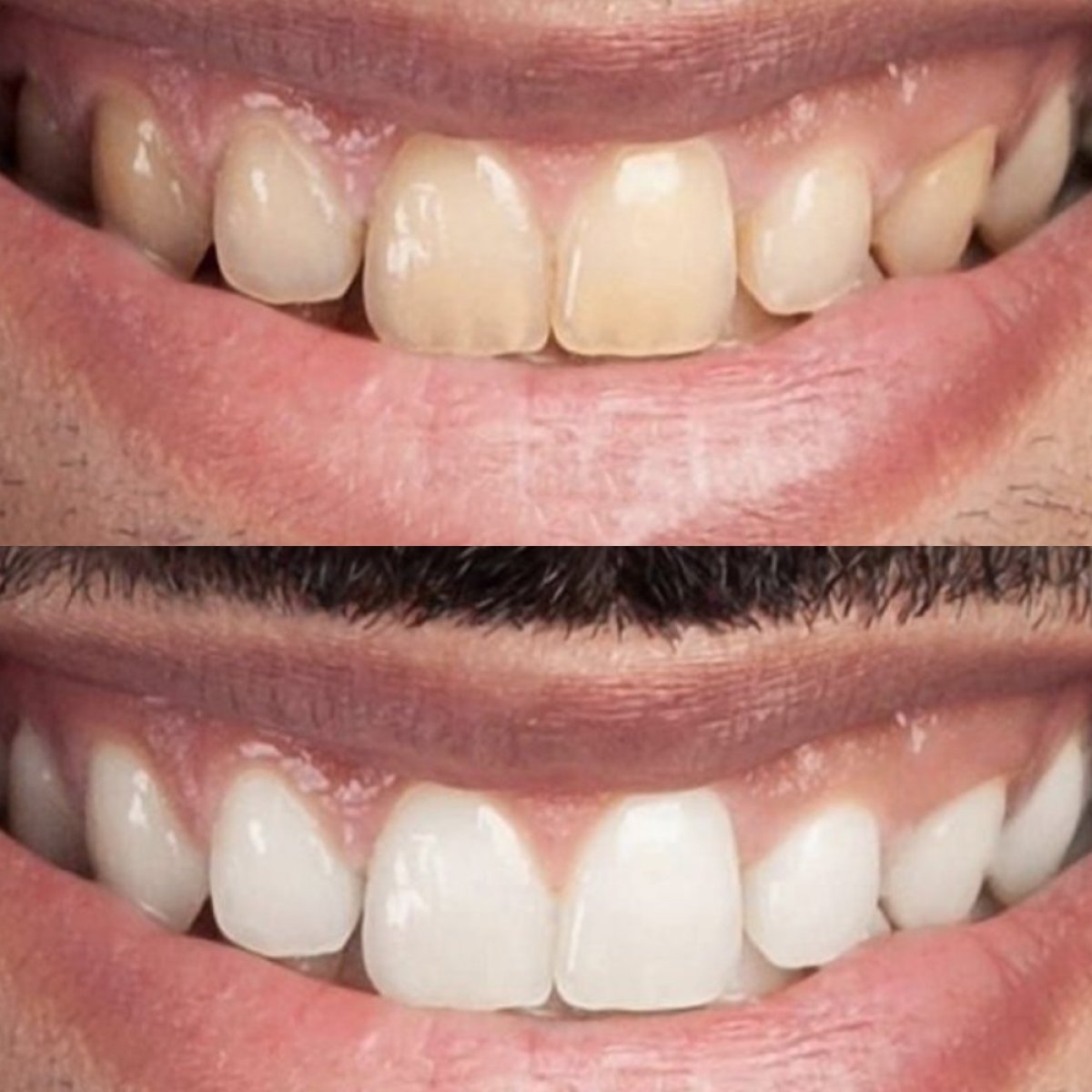Before and after tooth whitening results at Punta cana dentist odontologia familiar, brighter smile
