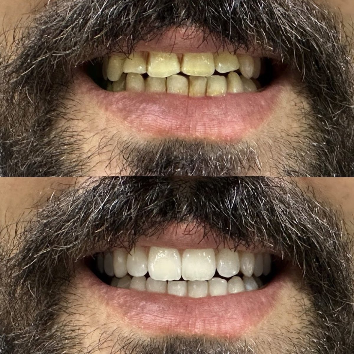 Before and after tooth whitening results at 360 Dental Clinic, visibly brighter smile