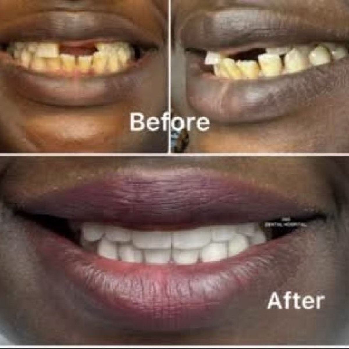 Before and after dental veneers at 360 Dental Clinic – smile makeover with natural results