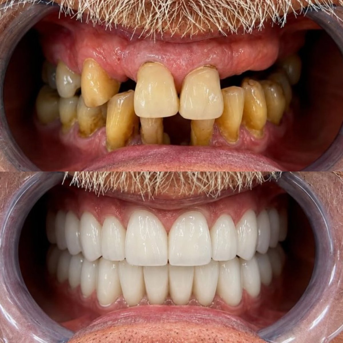 Vorher-nachher-Ergebnis Zahnimplantate bei 360 Dental Clinic – vollständige Zahnsanierung