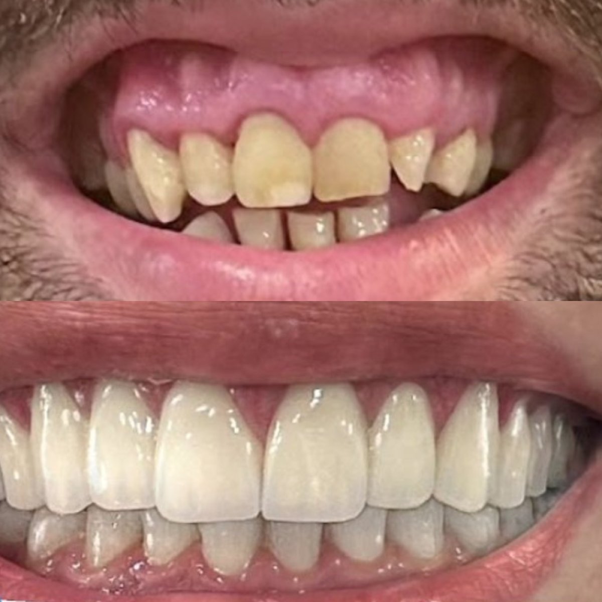 Vorher-nachher-Ergebnis der Gingivektomie bei 360 Dental Clinic, verbesserte Zahnästhetik