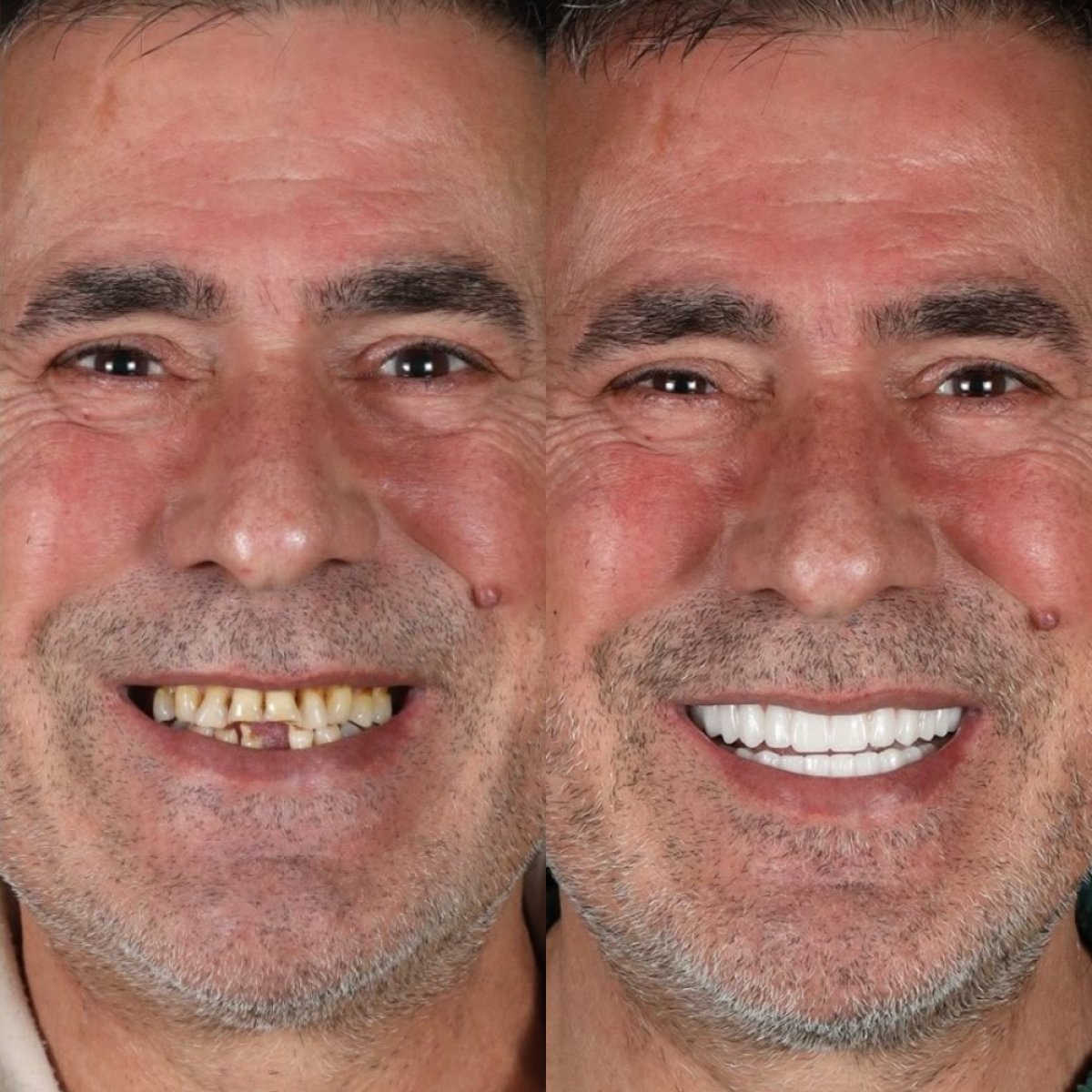 Vorher-nachher-Ergebnis Hollywood Smile bei Qualident Dental Clinic – vollständige Verwandlung