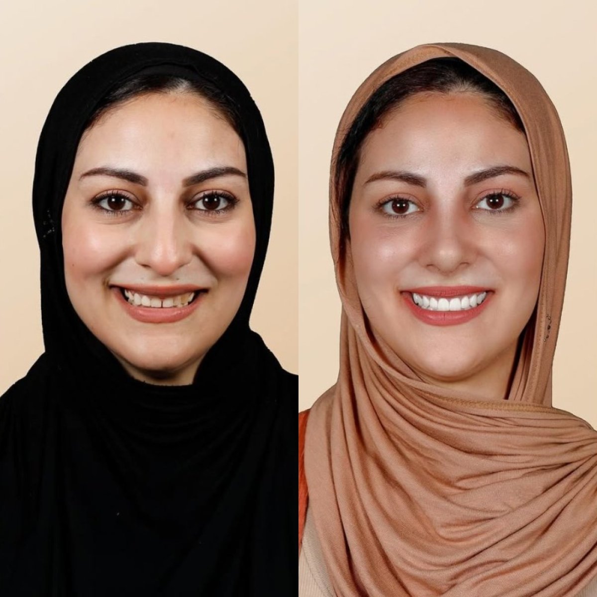 Результаты до и после улыбки в Qualident Dental Clinic – более яркие, ровные зубы
