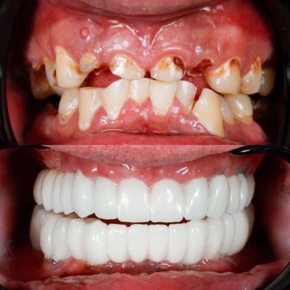 До и после преображения улыбки с имплантами в Qualident Dental Clinic, видимый результат