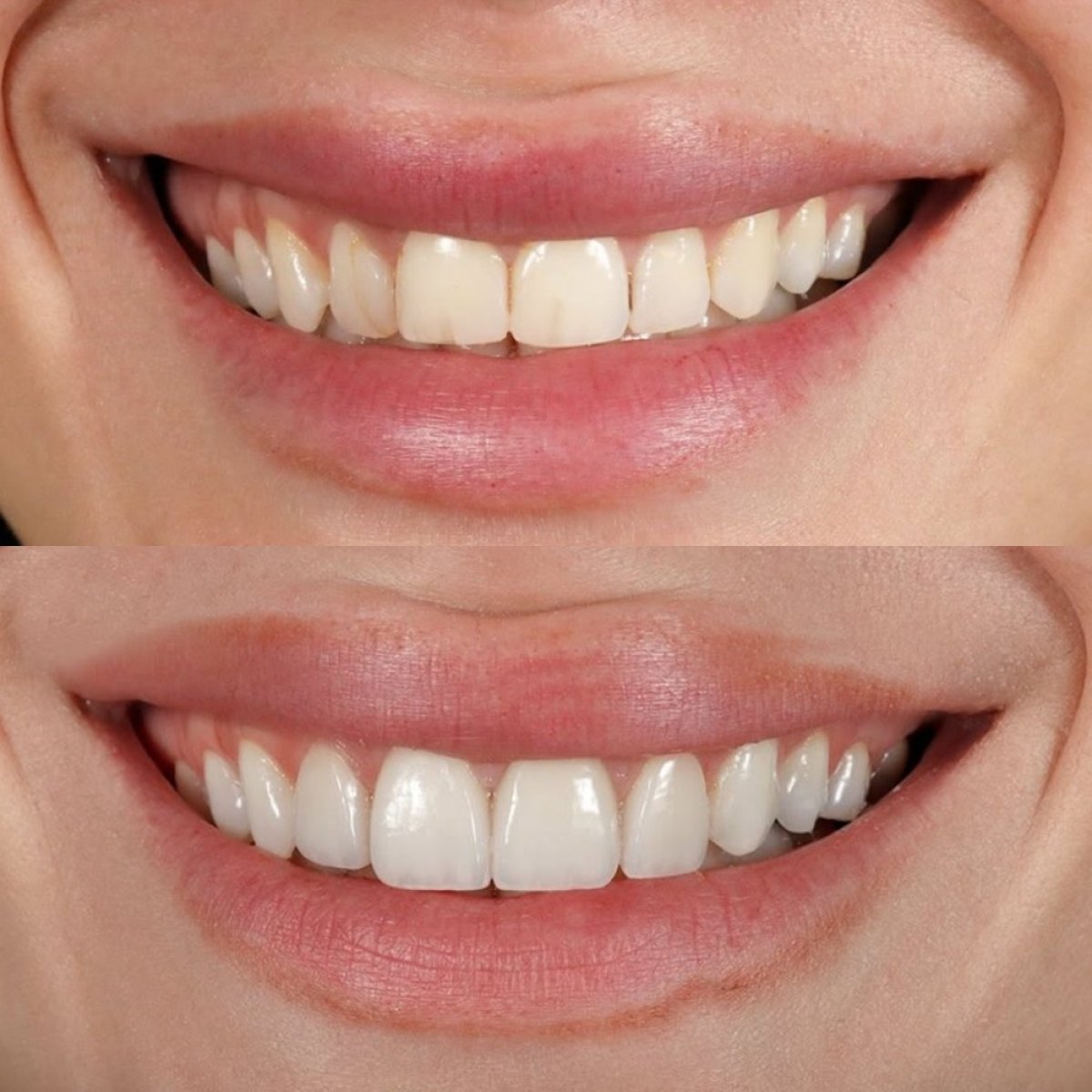 Avant/après facettes Emax à Qualident Dental Clinic – résultat transformation du sourire