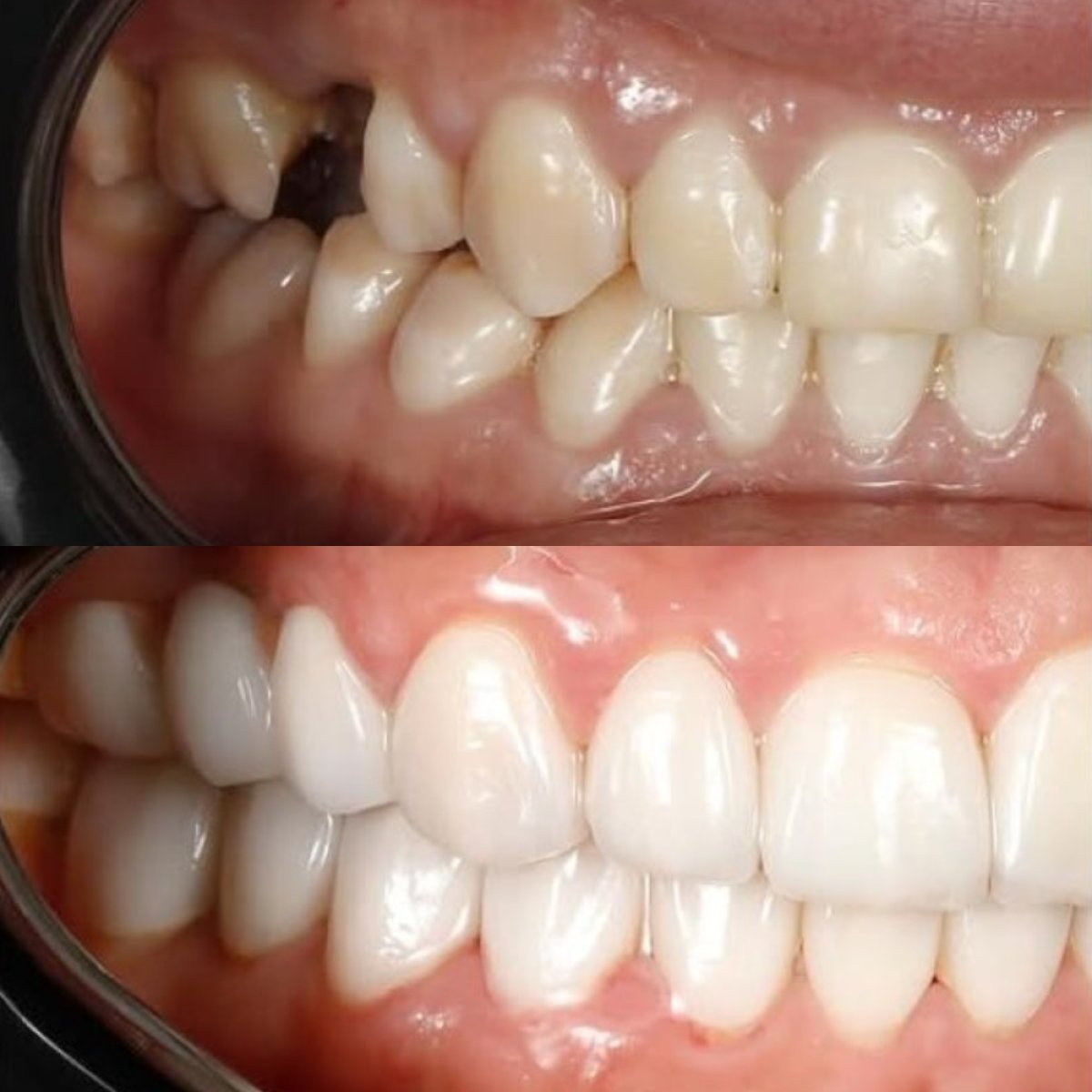 Результат до та після встановлення Emax вініри в Qualident Dental Clinic – покращення посмішки