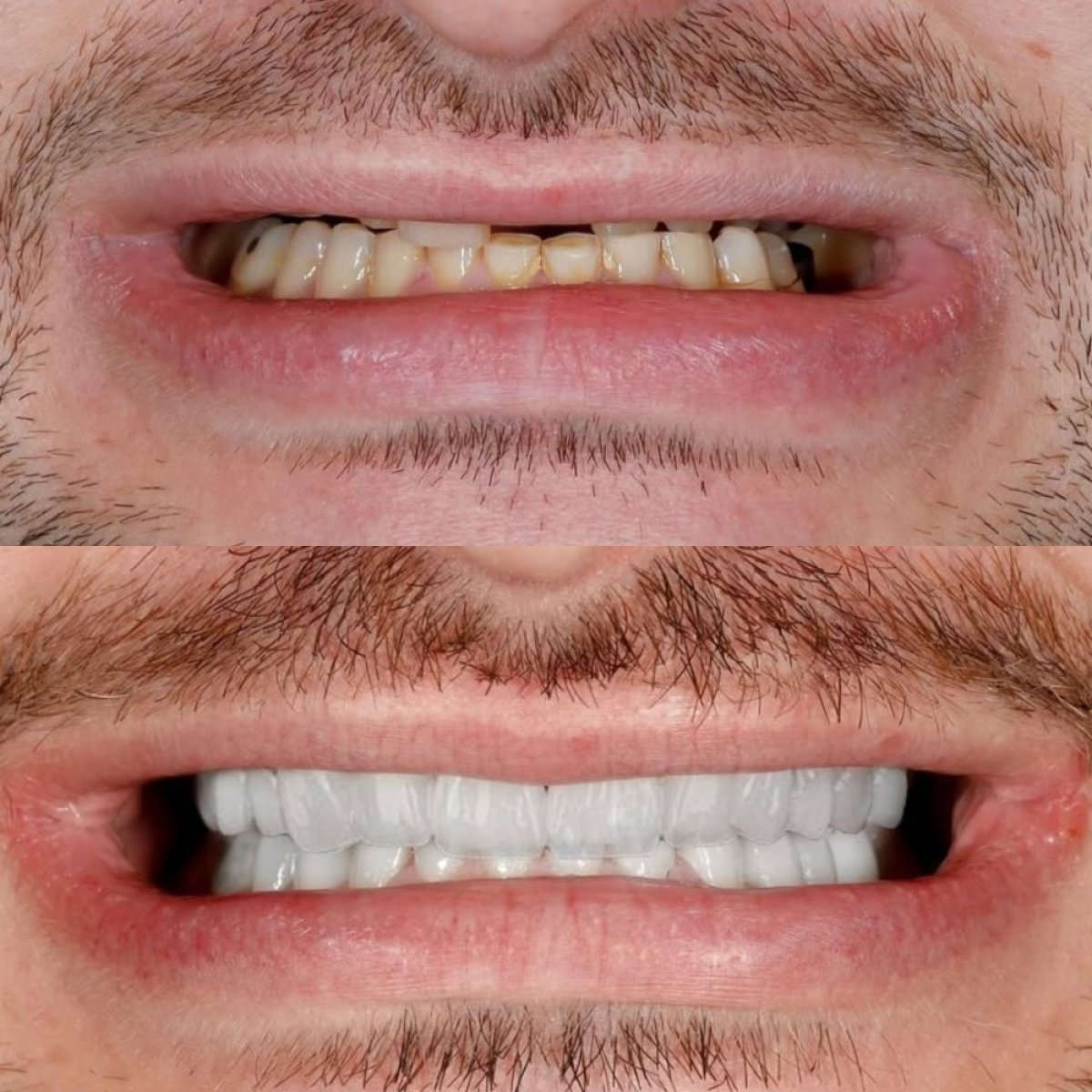 Résultat avant et après facettes Emax à Qualident Dental Clinic – transformation du sourire