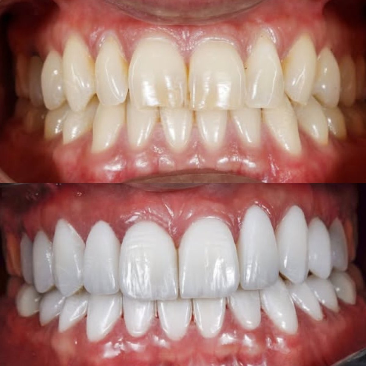 До та після встановлення вінірів у Qualident Dental Clinic – результат білої рівної усмішки
