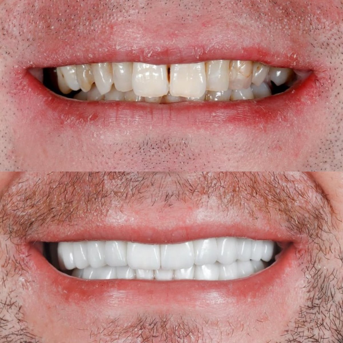 Результат до и после установки виниров Emax в Qualident Dental Clinic – преображение улыбки