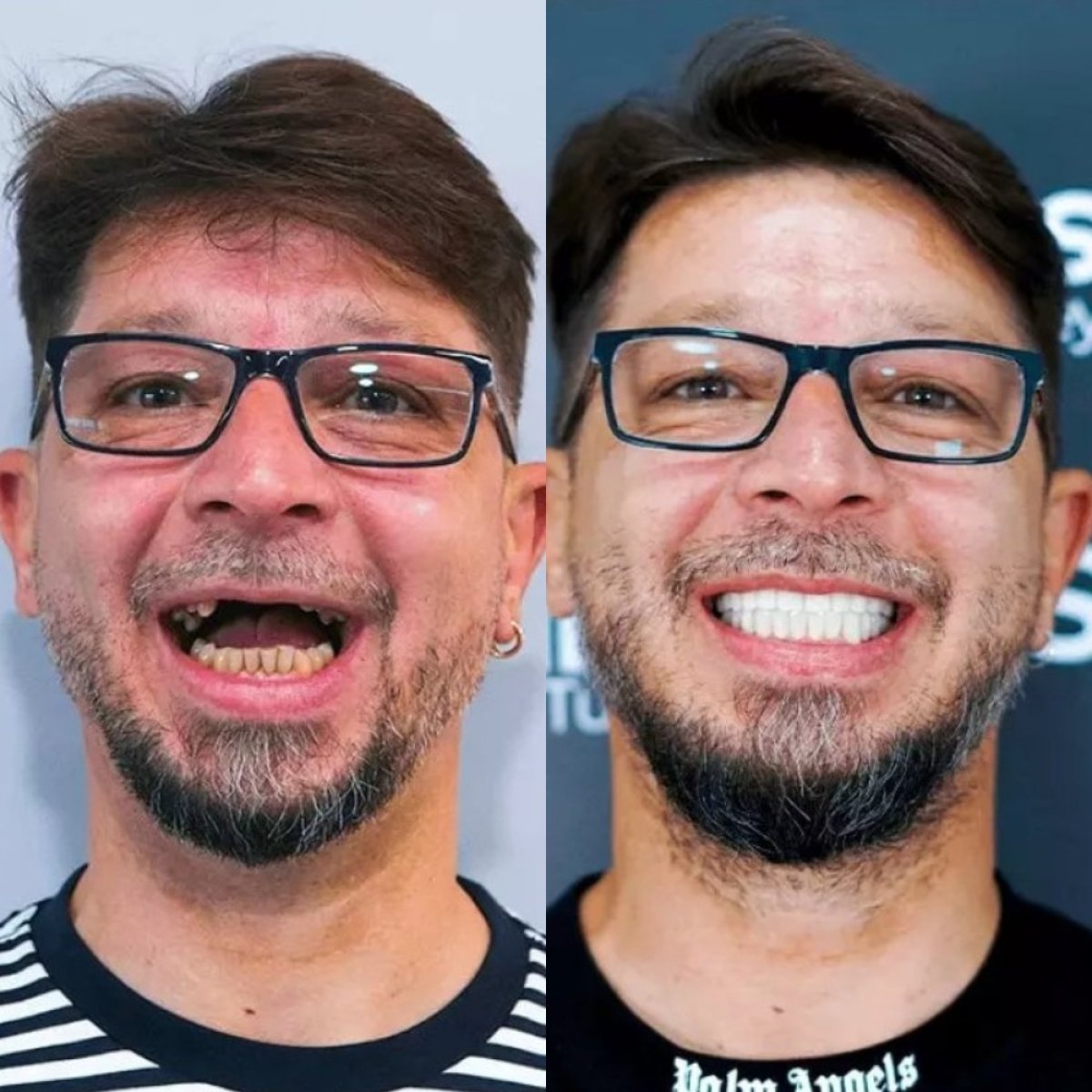Результати до і після імплантації зубів у SmilesTurkey – відновлена посмішка