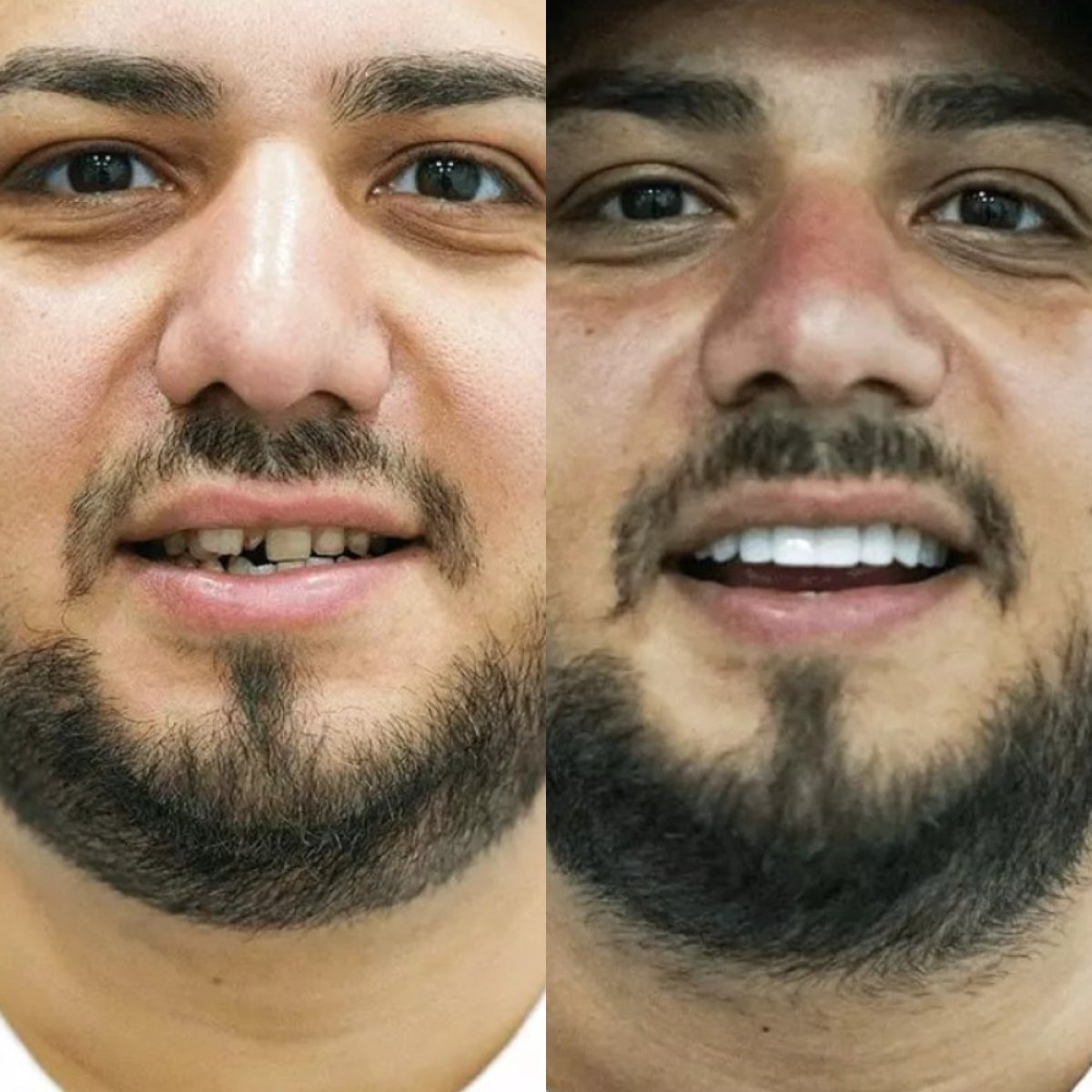 Antes y después de smile makeover en SmilesTurkey – carillas dentales para mejorar dientes
